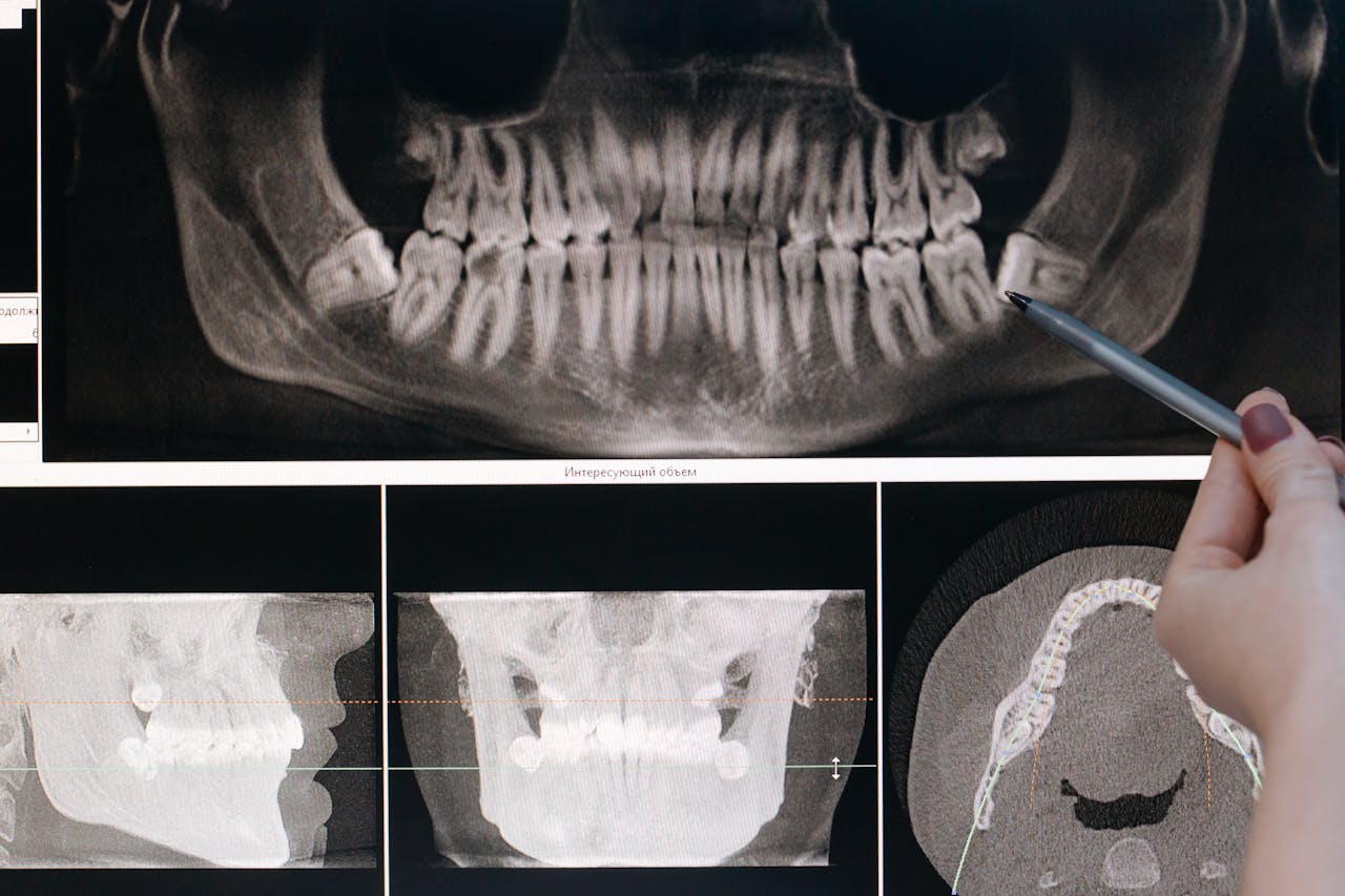 Detailed dental X-ray showing teeth structure highlighted by a pointing pen.